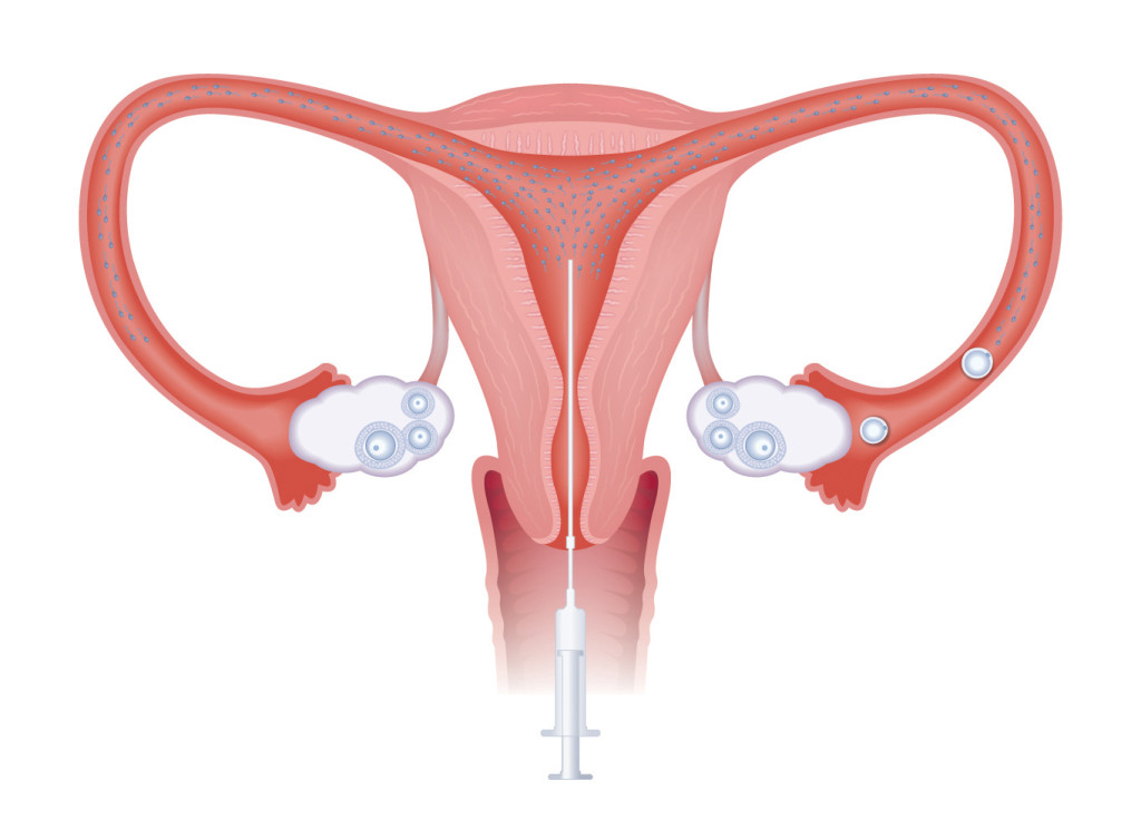iui
