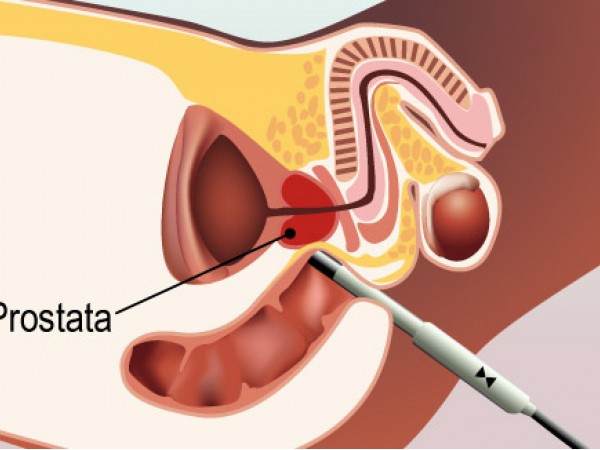 Ecografia prostatica